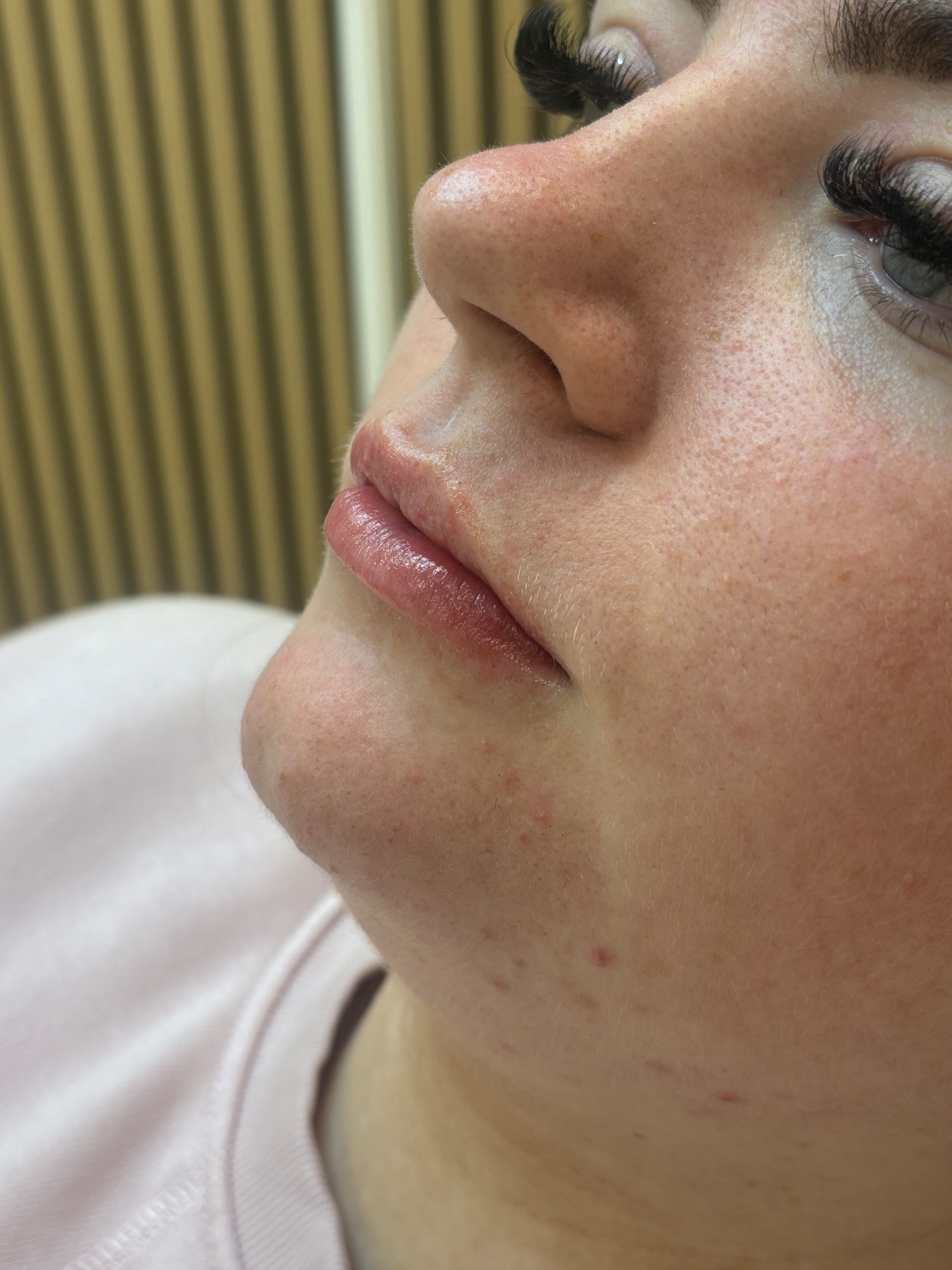 Lip filler side profile — subtle, natural projection