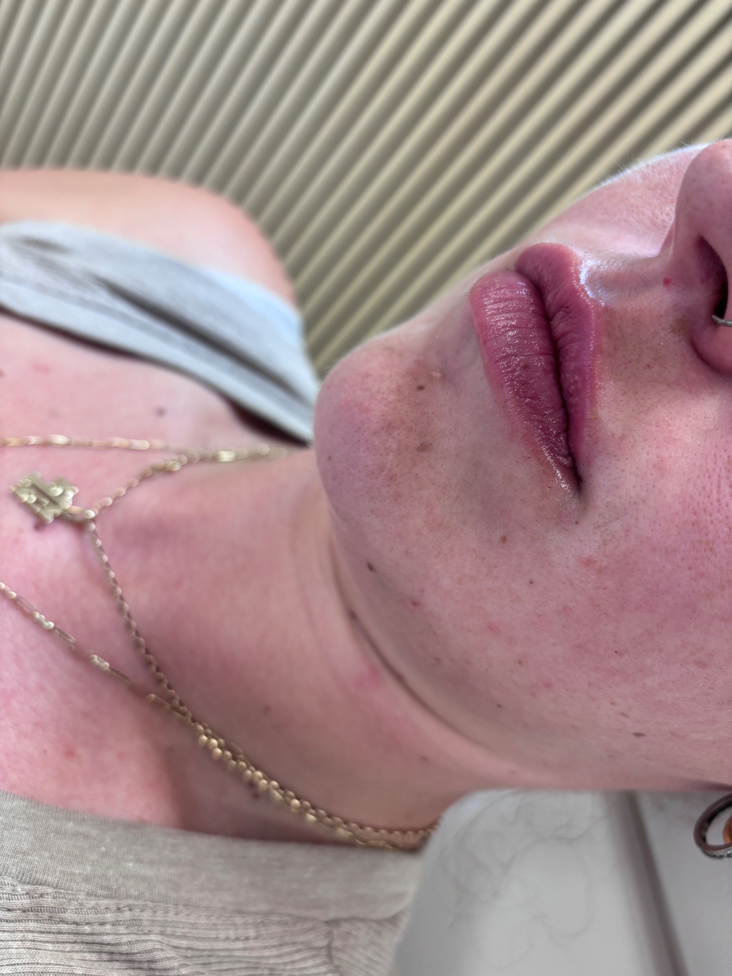 Lip filler result — fresh, natural volume