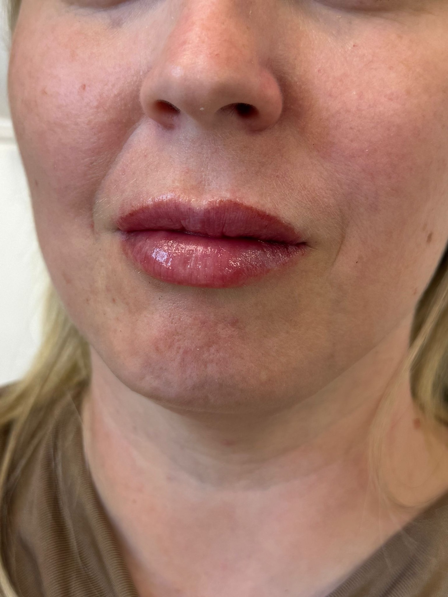 Lip filler result — natural, balanced enhancement