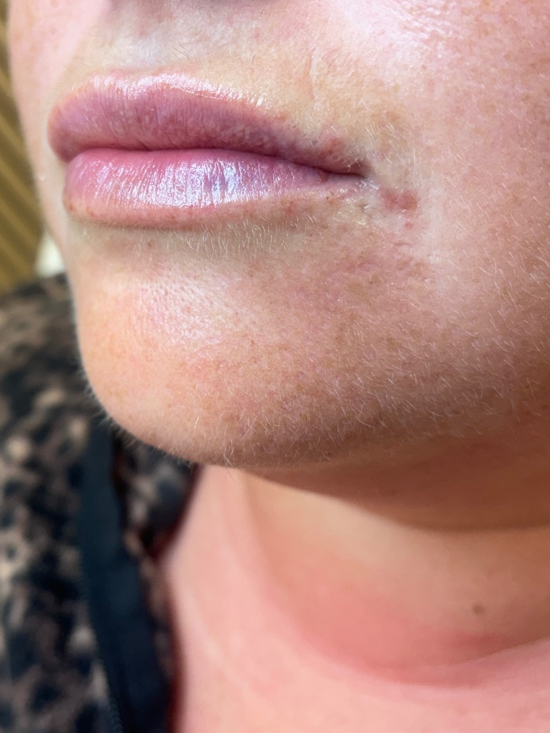 Lip filler result — soft, refined shape