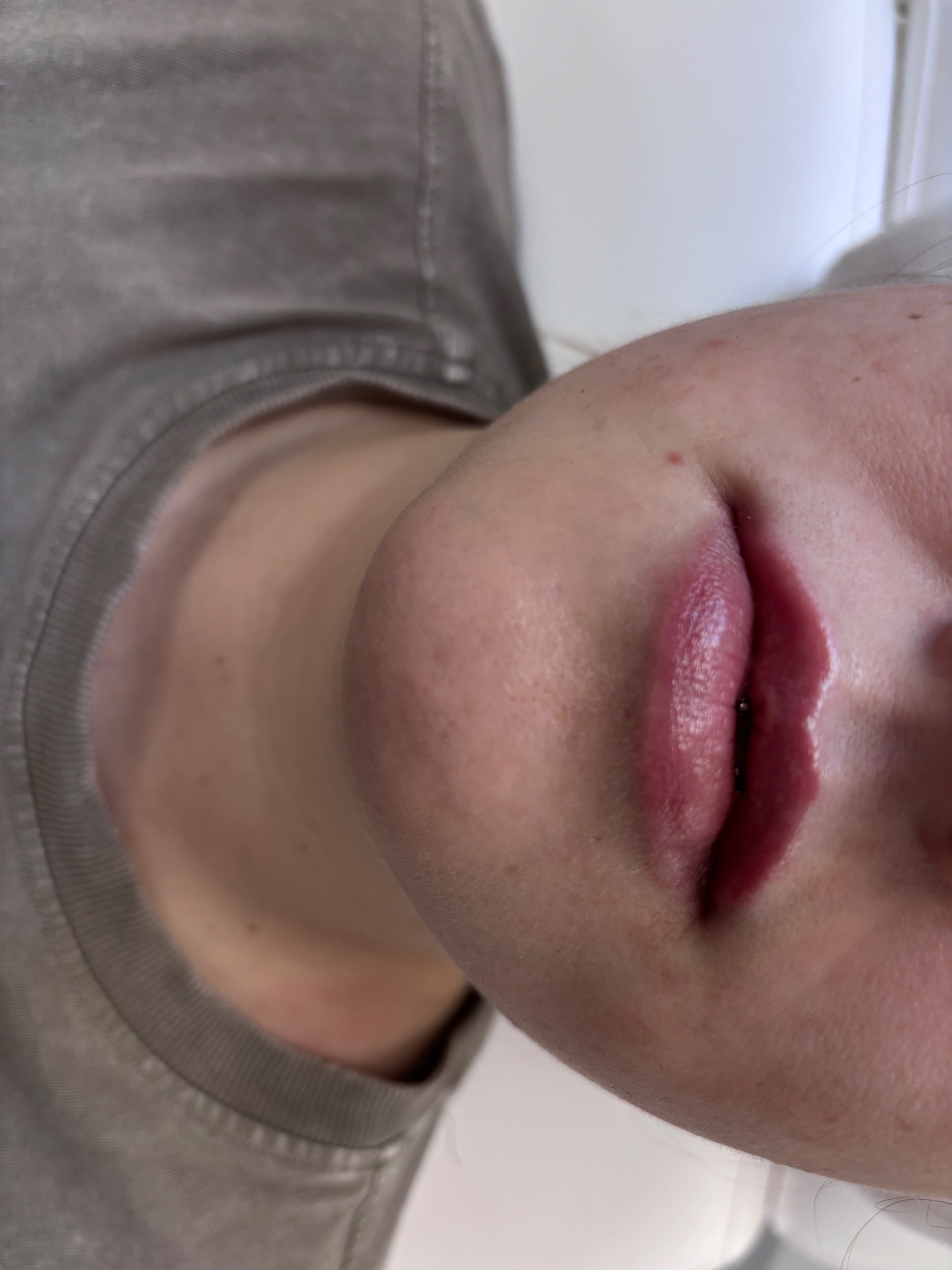 Lip filler close-up — defined border and hydrated finish